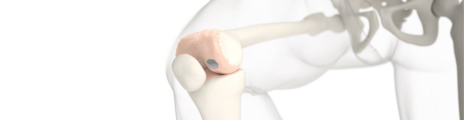 Mini-Implantat gegen Knorpelschaden im Knie